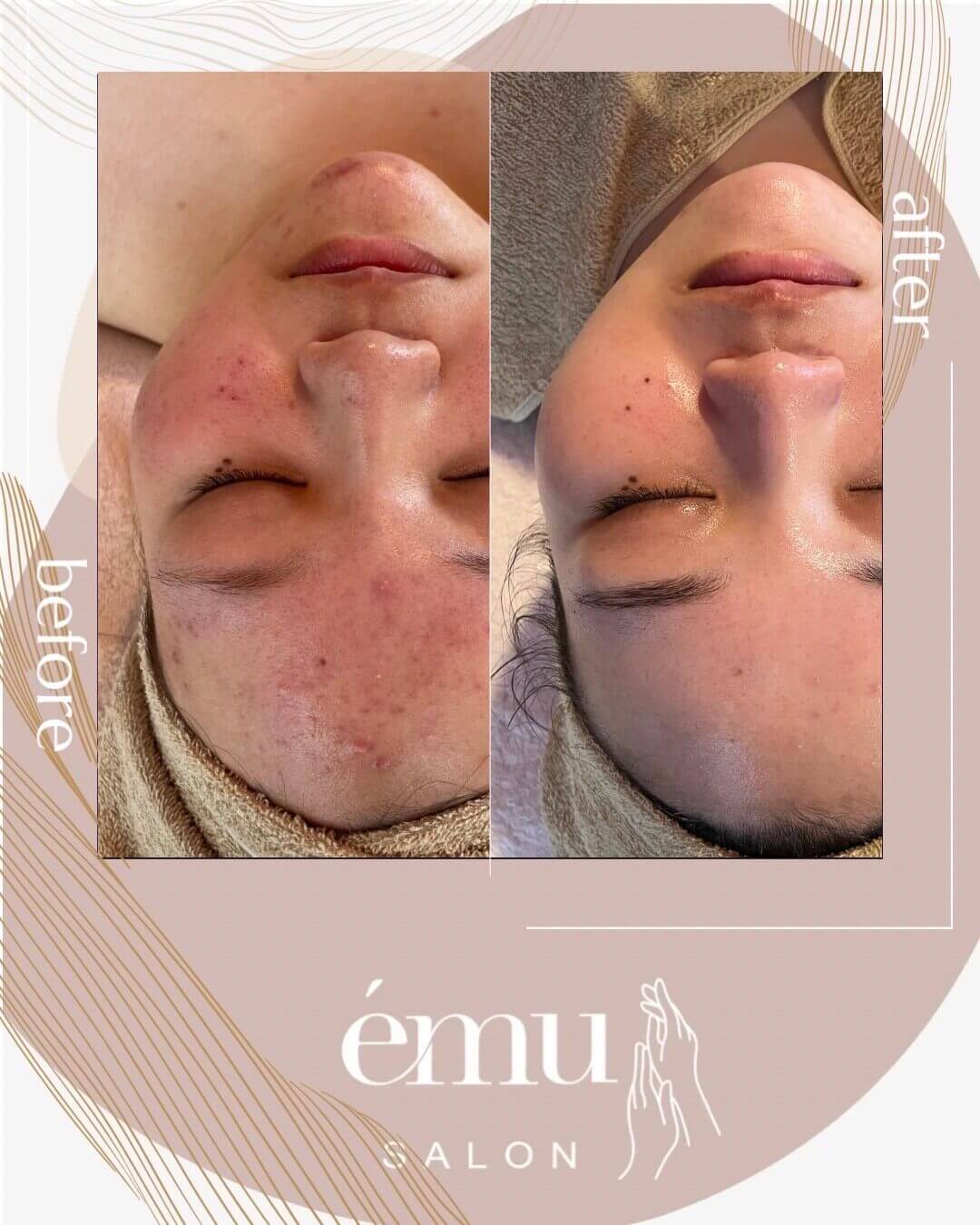 症例4｜REVI陶肌トリートメント